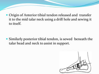  Origin of Anterior tibial tendon released and transfer
it to the mid talar neck using a drill hole and sewing it
to itself.
 Similarly posterior tibial tendon, is sewed beneath the
talar head and neck to assist in support.
 