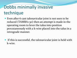 Dobbs minimally invasive
technique
 Even after 6 cast talonavicular joint is not seen to be
reduced (TAMBA>30) then an attempt is made in the
operating room to lever the talus into position
percutaneously with a k-wire placed into the talus in a
retrograde manner.
 If this is successful, the talonavicular joint is held with
k-wire.
 