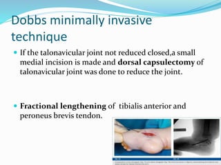 Dobbs minimally invasive
technique
 If the talonavicular joint not reduced closed,a small
medial incision is made and dorsal capsulectomy of
talonavicular joint was done to reduce the joint.
 Fractional lengthening of tibialis anterior and
peroneus brevis tendon.
 