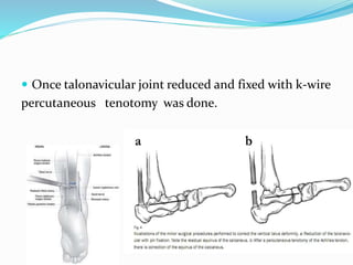  Once talonavicular joint reduced and fixed with k-wire
percutaneous tenotomy was done.
 