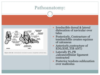 Congenital vertical talus BY DR.NAVEEN RATHOR | PPTX