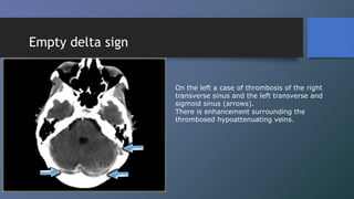 Cerebral Venous Thrombosis - Dr. KEO VEASNA | PDF