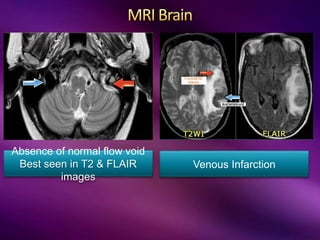 Absence of normal flow void
Best seen in T2 & FLAIR
images
Venous Infarction
 