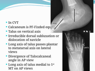 Navicle Comprehensive Overview of Congenital Vertical Talus: Anatomy, Diagnosis ...