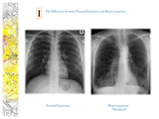 I   The Difference between Normal Expansion and Hyperexpansion




    Normal Expansion                             Hyperexpansion
                                                   “Elongated”
 