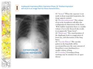Inadequate Inspiratory Effort, Expiration Phase, Or Shallow Inspiration
I    will result in an image that has these characteristics…

                                                   (1) “Stunted” When the exposure is not
                                                   made in deep suspended inspiration, the
                                                   image appears stunted.
                                                   (2) “Pseudocardiomegaly” The volume
                                                   of air in the hemithorax will affect the
                                                   configuration & dimensions of the heart .
                                                    With shallow inspiration there is a smaller
                                                   volume of air in the thorax & this results
                                                   in an apparently “larger heart”.
                                                   (3) “Diaphragm” The raised position of
                                                   the diaphragm leads to exaggeration of
                                                   heart size, and obscuration of the lung
                                                   bases.
                                                   (4) “Vascular Pattern” The vascular
                                                   pattern in the lung fields will be
                                                   accentuated because the same amount of
                                                   blood flow is now distributed to a
       EXPIRATION OR                               smaller volume of lung.
    SHALLOW INSPIRATION                            (5) “Crowding” Crowding of lung
                                                   markings may be mistaken for air space
                                                   disease
 