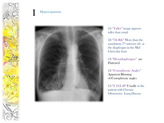 I   Hyperexpansion




                     (1) “Taller” image appears
                     taller than usual

                     (2) “7th Rib” More than the
                     mandatory 7th anterior rib at
                     the diaphragm in the Mid
                     Clavicular Line

                     (3) “Hemidiaphragms” are
                     Flattened

                     (3) “Costophrenic Angles”
                     Apparent Blunting
                     of Costophrenic angles

                     (5) “C.O.L.D” Usually in the
                     patient with Chronic
                     Obstructive Lung Disease
 