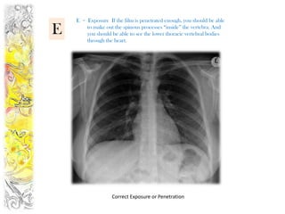 E = Exposure If the film is penetrated enough, you should be able

E       to make out the spinous processes “inside” the vertebra. And
        you should be able to see the lower thoracic vertebral bodies
        through the heart.




                   Correct Exposure or Penetration
 