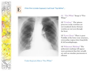 E   If the Film is Under Exposed, it will look “Too White”…


                                                     (1) “Too White” Image is “Too
                                                     White”

                                                     (2) “Vertebrae” The spinous
                                                     processes in the vertebrae are
                                                     not visualized. Lower thoracic
                                                     vertebra are not seen through
                                                     the heart

                                                     (3) “Lower Zones” There is poor
                                                     Visibility of the lower zone structures,
                                                     retrocardiac region, lower lung fields
                                                     & left hemidiaphragm.

                                                     (4) “Pulmonary Markings” The
                                                     pulmonary markings will appear
                                                     more prominent than they actually
                                                     are and can simulate pneumonia or
                                                     effusion

    Under Exposed, Film is “Too White”
 