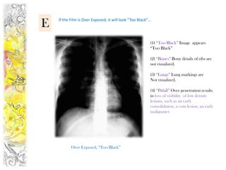 E   If the Film is Over Exposed, it will look “Too Black”…




                                                         (1) “Too Black” Image appears
                                                         “Too Black”

                                                         (2) “Bones” Bony details of ribs are
                                                         not visualized.

                                                         (3) “Lungs” Lung markings are
                                                         Not visualized.

                                                         (4) “Pitfall” Over penetration results
                                                         in loss of visibility of low density
                                                         lesions, such as an early
                                                         consolidation, a coin lesion, an early
                                                         malignancy




           Over Exposed, “Too Black”
 