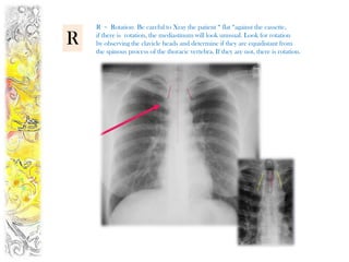 R = Rotation Be careful to Xray the patient “ flat “against the cassette,

R   if there is rotation, the mediastinum will look unusual. Look for rotation
    by observing the clavicle heads and determine if they are equidistant from
    the spinous process of the thoracic vertebra. If they are not, there is rotation.
 