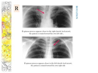 ROTATION
R



    If spinous process appears closer to the right clavicle (red arrow),
              the patient is rotated toward his own left side .




       If spinous process appears closer to the left clavicle (red arrow),
                the patient is rotated toward his own right side
 