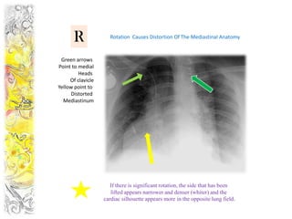 R              Rotation Causes Distortion Of The Mediastinal Anatomy



 Green arrows
Point to medial
         Heads
     Of clavicle
Yellow point to
      Distorted
  Mediastinum




                      If there is significant rotation, the side that has been
                      lifted appears narrower and denser (whiter) and the
                   cardiac silhouette appears more in the opposite lung field.
 