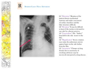 R   Rotation Causes These Aberrations




                                        (1) “Distortion” Rotation of the
                                        patient distorts mediastinal
                                        anatomy and makes assessment
                                        of cardiac chambers and the
                                        hilar structures difficult.
                                        (2) “Deviation” It may be difficult
                                        to know if the trachea is deviated to
                                        one side by a disease process.
                                        (3) “Transradiant” The “darker”
                                        lung field is the side nearer to the
                                        film.
                                        (4) “Magnification” Severe rotation
                                        may make the pulmonary arteries
                                        appear larger on the side farther
                                        from the film.
                                        (3) “Asymmetry” Changes in lung
                                        density due to asymmetry of
                                        overlying soft-tissue may be
                                        incorrectly interpreted as lung disease.
 