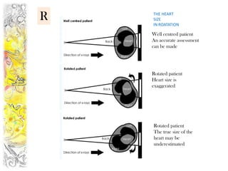 R   THE HEART
    SIZE
    IN ROATATION

    Well centred patient
    An accurate assessment
    can be made




    Rotated patient
    Heart size is
    exaggerated




    Rotated patient
    The true size of the
    heart may be
    underestimated
 