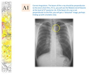 Correct Angulation. The beam of the x-ray should be perpendicular
A1   to the erect chest film, if it is, you will see the Medial end of Clavicle
     at the level of 3rd posterior rib. If the beam of x-ray is not
     perpendicular to the film, you will get a "distorted" image, perhaps
     Ending up with a lordotic view.
 