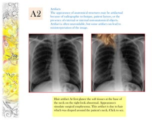 Artifacts

A2   The appearance of anatomical structures may be artifactual
     because of radiographic technique, patient factors, or the
     presence of external or internal non-anatomical objects.
     Artifact is often unavoidable, but some artifact can lead to
     misinterpretation of the image.




        Hair artifact At first glance the soft tissues at the base of
        the neck on the right look abnormal. Appearances
        simulate surgical emphysema. This artifact is due to hair
        which was draped around the patient's neck. Click to see.
 