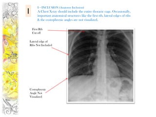 I = INCLUSION (Anatomy Inclusion)
I        A Chest X-ray should include the entire thoracic cage. Occasionally,
         important anatomical structures like the first rib, lateral edges of ribs
         & the costophrenic angles are not visualized.

     First Rib
     Cut off

    Lateral edge of
    Ribs Not Included




    Costophrenic
    Angle Not
    Visualized
 