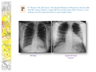 P   P = Position PA, AP, Lateral. The Standard Position or Projection is the Erect PA
    The ICU patient will have a supine AP view and the image will be “fuzzier”, a first
    look gives you the impression that it is a poor quality image.




       PA View                                        Supine AP View
                                                        “Fuzzier”
 