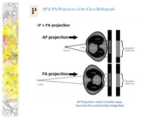 AP & PA Projections of the Chest Radiograph
P




                        AP Projection: Heart is further away
                       from the film and therefore Magnified
 