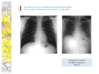 I   The difference between an Inspiration and an Expiration Film.
    The one taken in Expiration looks “stunted”…(on the right).




                                                            Sometimes we ask for
                                                            A CXR in expiration…
                                                                  When?
 