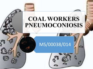 COAL WORKERS
PNEUMOCONIOSIS
MS/00038/014
Wednesday, June 7, 2017
 