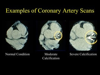 Examples of Coronary Artery ScansExamples of Coronary Artery Scans
Normal ConditionNormal Condition ModerateModerate
CalcificationCalcification
Severe CalcificationSevere Calcification
 