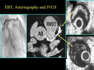 EBT, Arteriography and IVUSEBT, Arteriography and IVUS
 