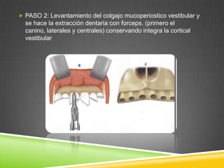  PASO 2: Levantamiento del colgajo mucoperiostico vestibular y

se hace la extracción dentaria con forceps. (primero el
canino, laterales y centrales) conservando integra la cortical
vestibular

 