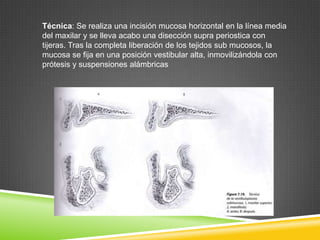 Técnica: Se realiza una incisión mucosa horizontal en la línea media
del maxilar y se lleva acabo una disección supra periostica con
tijeras. Tras la completa liberación de los tejidos sub mucosos, la
mucosa se fija en una posición vestibular alta, inmovilizándola con
prótesis y suspensiones alámbricas

 