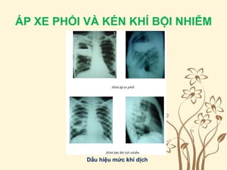 ÁP XE PHỔI VÀ KÉN KHÍ BỘI NHIỄM
Dấu hiệu mức khí dịch
 