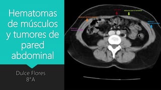 Hematomas
de músculos
y tumores de
pared
abdominal
 