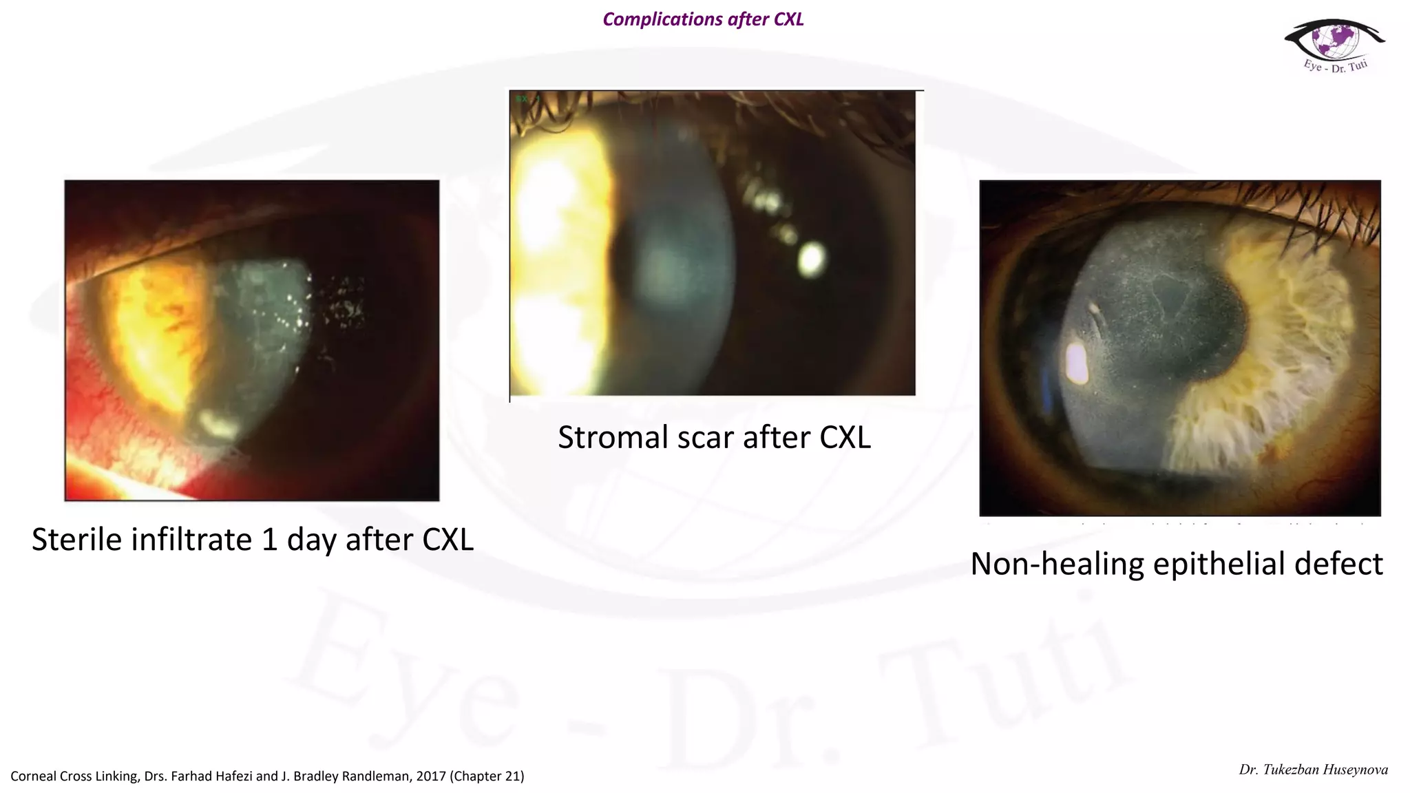Corneal Cross Linking: Protocols and literature review | PDF