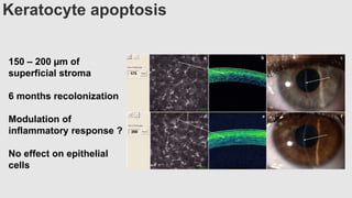 Keratocyte apoptosis
150 – 200 µm of
superficial stroma
6 months recolonization
Modulation of
inflammatory response ?
No effect on epithelial
cells
 