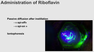 Administration of Riboflavin
Passive diffusion after instillation
- « epi-off»
- « epi-on »
Iontophoresis
 