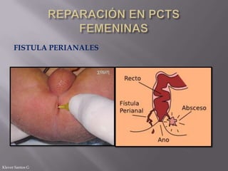 FISTULA PERIANALES

Klever Santos G

 