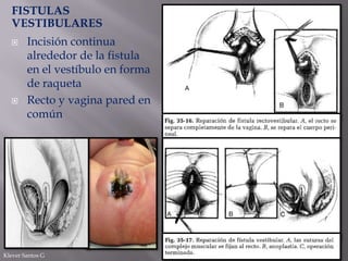 FISTULAS
VESTIBULARES




Incisión continua
alrededor de la fistula
en el vestíbulo en forma
de raqueta
Recto y vagina pared en
común

Klever Santos G

 