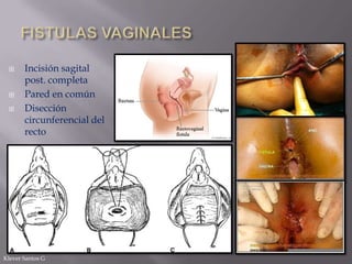 




Incisión sagital
post. completa
Pared en común
Disección
circunferencial del
recto

Klever Santos G

 