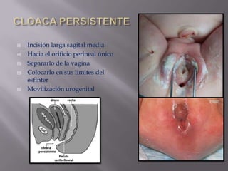 






Incisión larga sagital media
Hacia el orificio perineal único
Separarlo de la vagina
Colocarlo en sus limites del
esfínter
Movilización urogenital

 