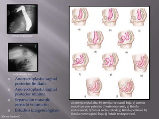 Fístula rectouretral

malformación baja








Anorrectoplastia sagital
posterior limitada
Anorrectoplastia sagital
posterior mínima
Separación musculo
estriado voluntario
Estudios imagenológicos

Klever Santos G

a) atresia rectal alta; b) atresia rectoanal baja; c) atresia
rectal con ano patente; d) estenosis anal; e) fístula
rectovesical; f) fístula rectouretral; g) fístula perineal; h)
fístula rectovaginal baja; j) fístula rectoperineal.

 