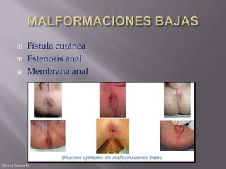 



Fístula cutánea
Estenosis anal
Membrana anal

Klever Santos G

 