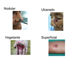 Nodular Ulcerado Superficial Vegetante 