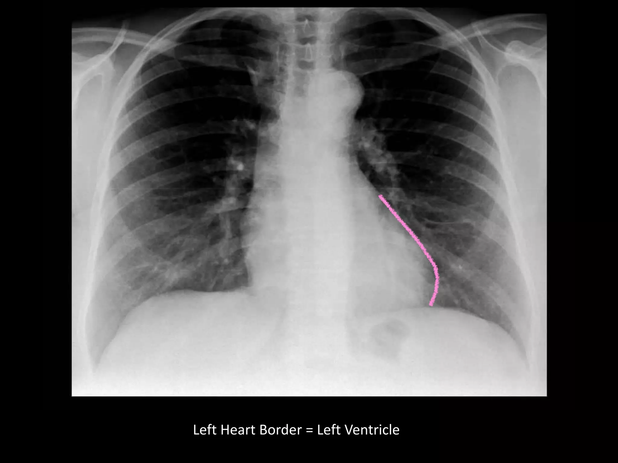 CXR Interpretation for Med Students | PPTX