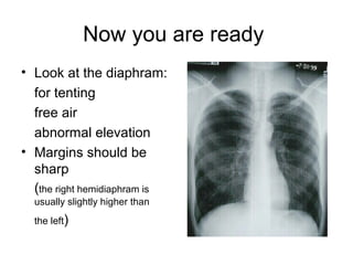 Now you are ready
• Look at the diaphram:
for tenting
free air
abnormal elevation
• Margins should be
sharp
(the right hemidiaphram is
usually slightly higher than
the left)
 