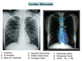 Cardiac Silhouette
1. R Atrium
2. R Ventricle
3. Apex of L Ventricle
4. Superior Vena Cava
5. Inferior Vena Cava
6. Tricuspid Valve
7. Pulmonary Valve
8. Pulmonary Trunk
9. R PA 10. L PA
 