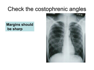 Check the costophrenic angles
Margins should
be sharp
 
