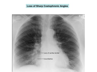 Loss of Sharp Costophrenic Angles
 