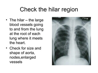 Check the hilar region
• The hilar – the large
blood vessels going
to and from the lung
at the root of each
lung where it meets
the heart.
• Check for size and
shape of aorta,
nodes,enlarged
vessels
 