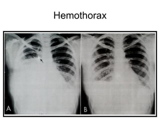 Hemothorax
 