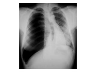 Chest x ray